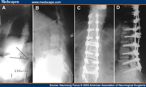 A and B Preoperative AP and lateral x-ray films_ C and D Postoperative AP