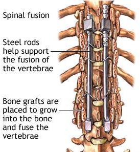 Steel rods