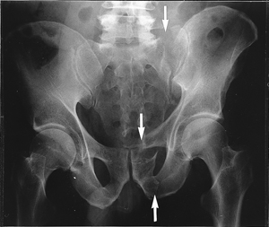 fractured pubic ramus